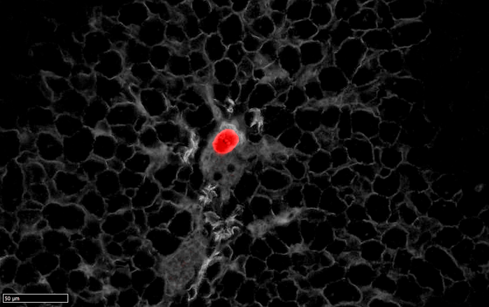 Residual colorectal cancer tumor cell extravasating from a liver portal vein.