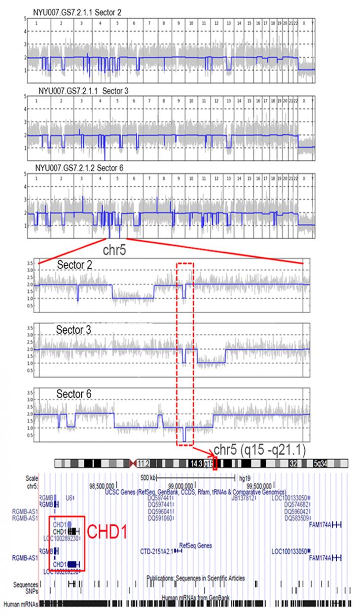 Spotting a Kley Mutation in One Prostate Tumor