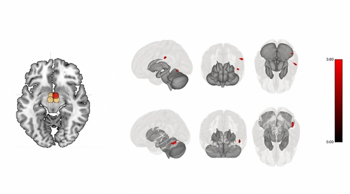 Post-bariatric surgery exercise modulates brain