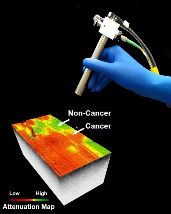 Imaging Technology Identifies Invasive Brain Cancer (1 of 4)