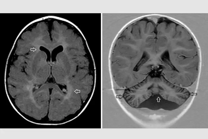 Brain scans of a patient with rare genetic disease caused by variants in CCT3