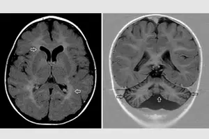 Brain scans of a patient with rare genetic disease caused by variants in CCT3