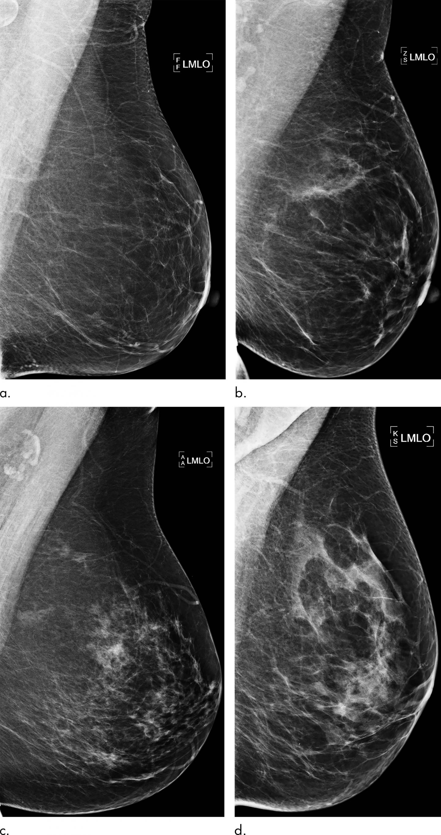 AI Improves Breast Cancer Risk Prediction