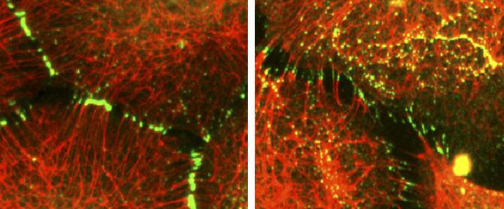 Desmoplakin Goes Awry