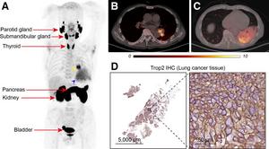 PET/CT imaging of patient with primary lung cancer