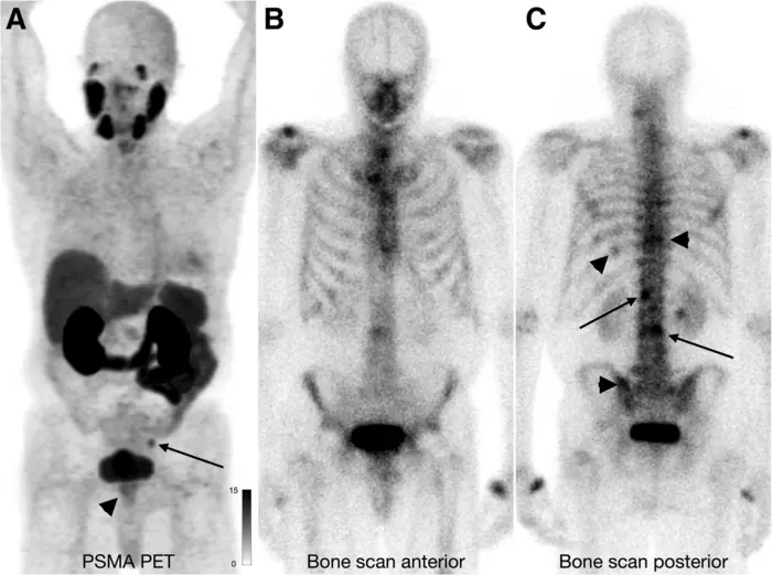 A 74-y-old man at initial staging with PSMA PET.