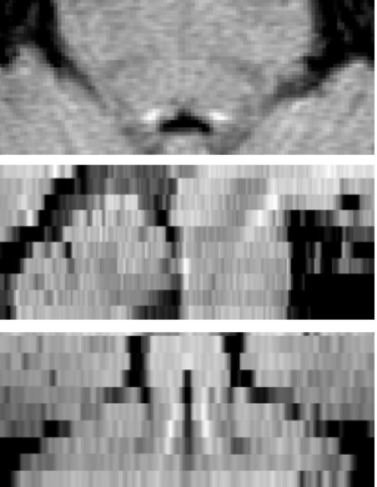 Locus coeruleus in 3T scan