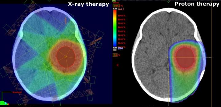 How safe is proton therapy for children?