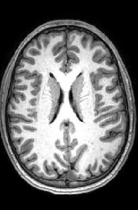 MRI Brain Scan
