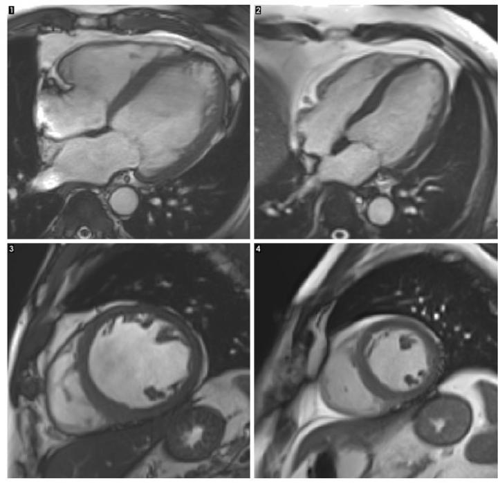 An MRI Scan of a Heart with Alcoholic Cardiomyopathy (Left) Compared with a Healthy Heart (Right)