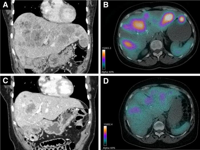 Patient who received 3 [90Y]Y-DOTATOC and 1 [177Lu]Lu-DOTATOC therapy cycles