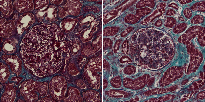 kidney sections from healthy control (left) and COVID-19 patient (right). Scar tissue is blue.