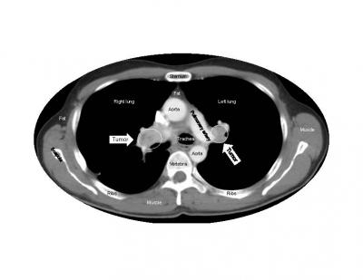 Reassuring Evidence: Anticancer Drug Does not Accelerate Tumor Growth after Treatment Ends (2 of 2)