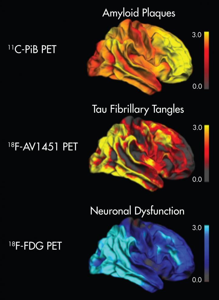 Topographical Correspondence of Tau -- but not Amyloid-Pathology with Neuronal Dysfunction in Alzhei