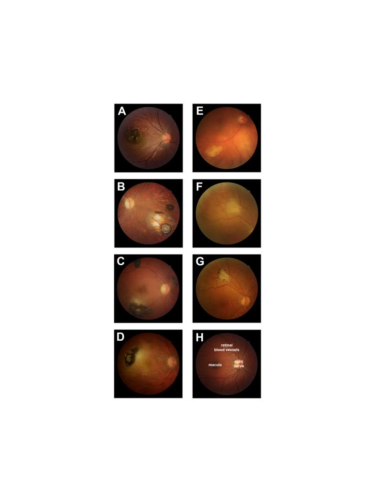 Ocular Toxoplasmosis in the Group of Humans