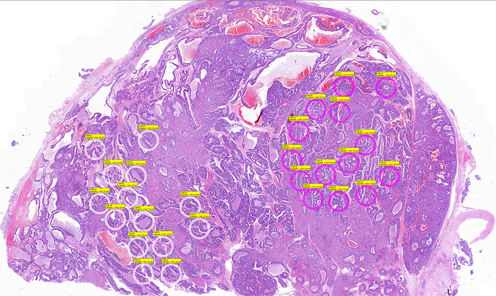 Brain metastasis of prostate cancer