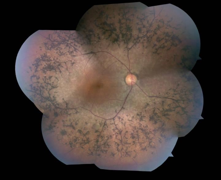 Retinitis Pigmentosa