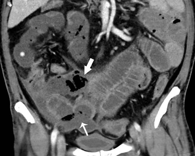 Imaging Reveals Bowel Abnormalities in Patients with COVID-19