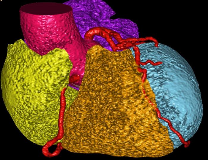 AI-enhanced heart CT