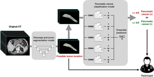 AI Helps Detect Pancreatic Cancer