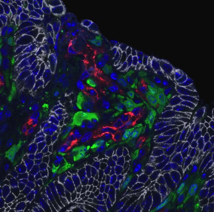 IL-11+ cells are located adjacent to tumor cells