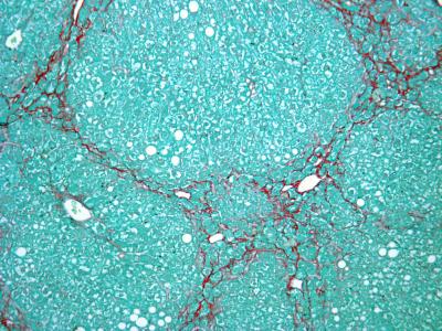 Sunshine Hormone, Vitamin D, May Offer Hope for Treating Liver Fibrosis