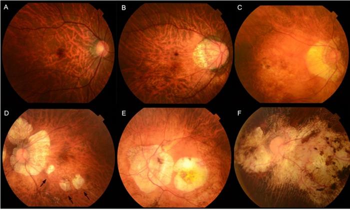 Figure 1: Fundus photographs showing different types of myopic maculopathy