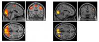 Brain Scans of Contact Sport Versus Noncontact Sport Players