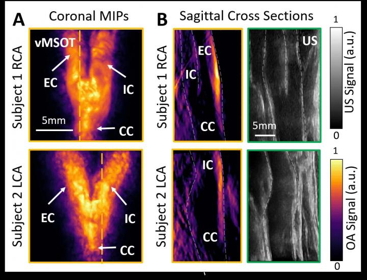 Novel Technique Accurately Assesses Cardiovascular Risks