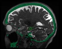 Focused Ultrasound May Open Door to Alzheimer's Treatment