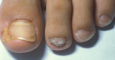 Tinea of the nails underdiagnosed in children