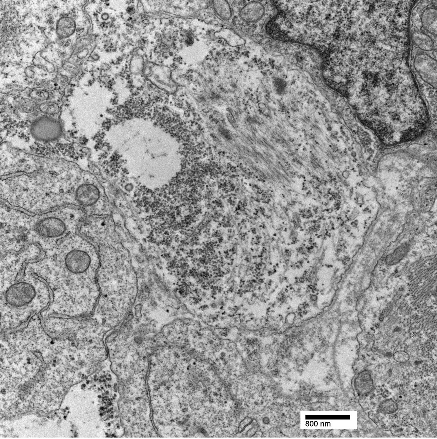 Rhabdomyosarcoma