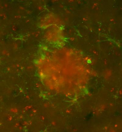 Attacking Alzheimer's Plaques