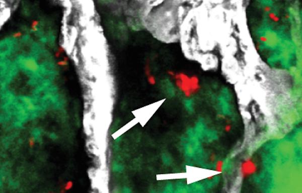 Sleeping Cancer Cells in Bone