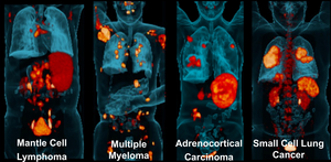 Most intense 68Ga-PentixaFor PET signal.