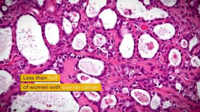 The Inner Workings of Ovarian Cancer