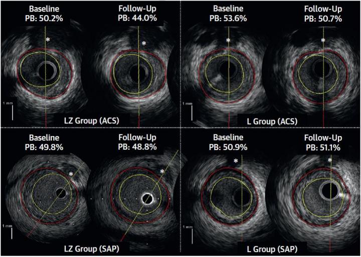 Plaque Progression/Regression