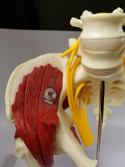 Biodegradable Implant