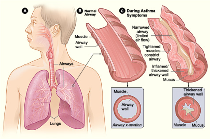 Key physiological differences between a normal lung airway  and a lung airway in a person experiencing asthma symptoms