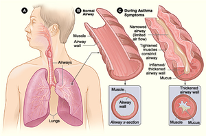 Key physiological differences between a normal lung airway  and a lung airway in a person experiencing asthma symptoms