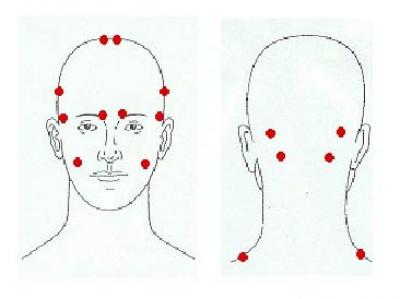 Migraine Trigger Points