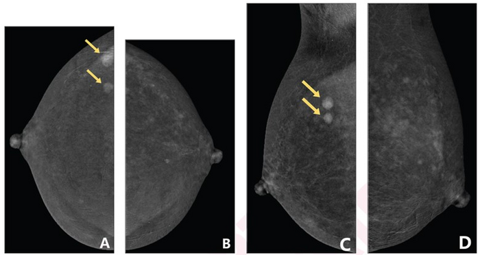 48-year-old woman who underwent CEM to evaluate two masses (arrows) in right breast