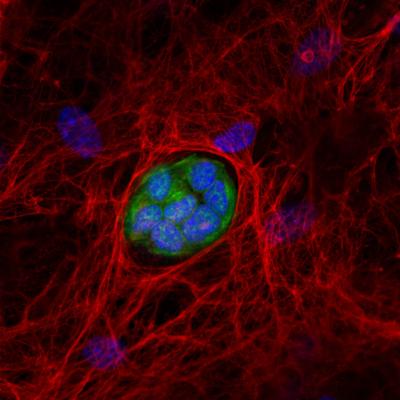 A Metastasis in its Nest