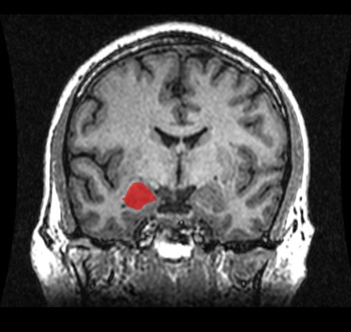 MRI Imaging of the Brain/Amygdala