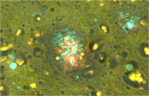 Amyloid-Beta (Green Fluorescence) and Aluminum (Orange Fluorescence)