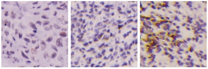 PGAM1 Suppression Sensitizes Tumors to Olaparib