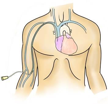 PICC Line