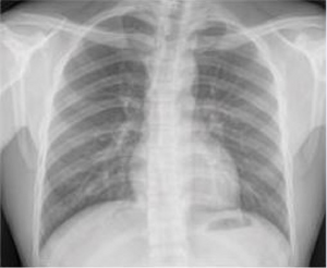 AI Predicts Heart Disease Risk Using Single X-Ray