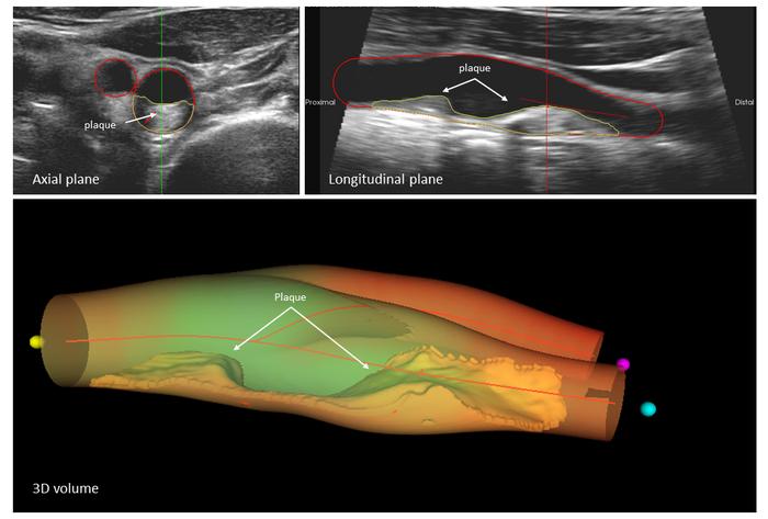 A large atherosclerotic plaque in a carotid artery