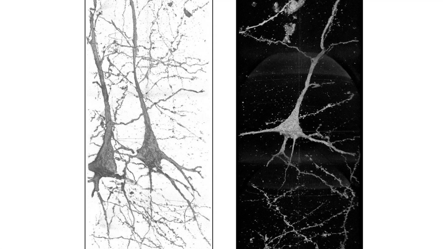 3D Images of Neurons in the Brain of a Schizophrenia Patient